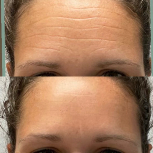Forehead Wrinkle Patch (Pack of 144 Patches)