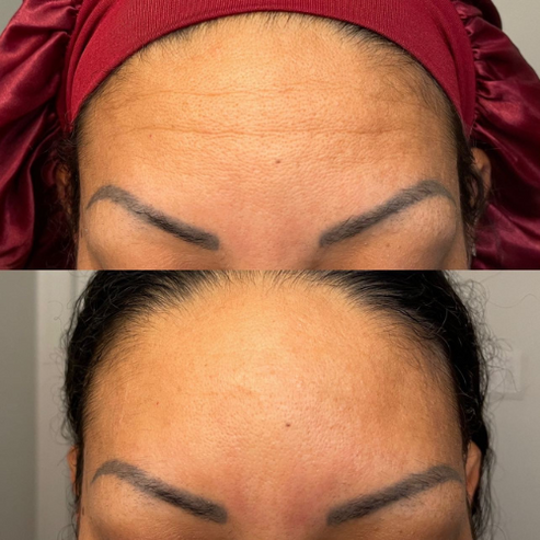 Forehead Wrinkle Patch (Pack of 144 Patches)