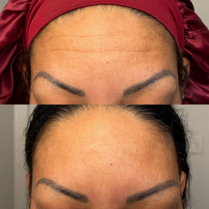 Forehead Wrinkle Patch (Pack of 144 Patches)